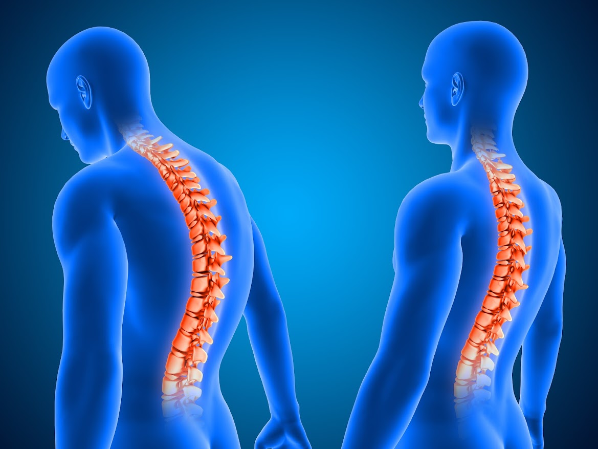 Posture Correction in Phoenix