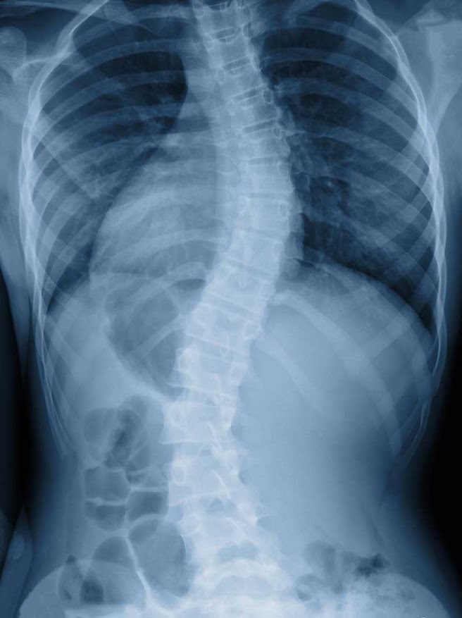 Scoliosis Treated in Phoenix